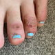 Teenage patient four weeks after the onset of symptoms.